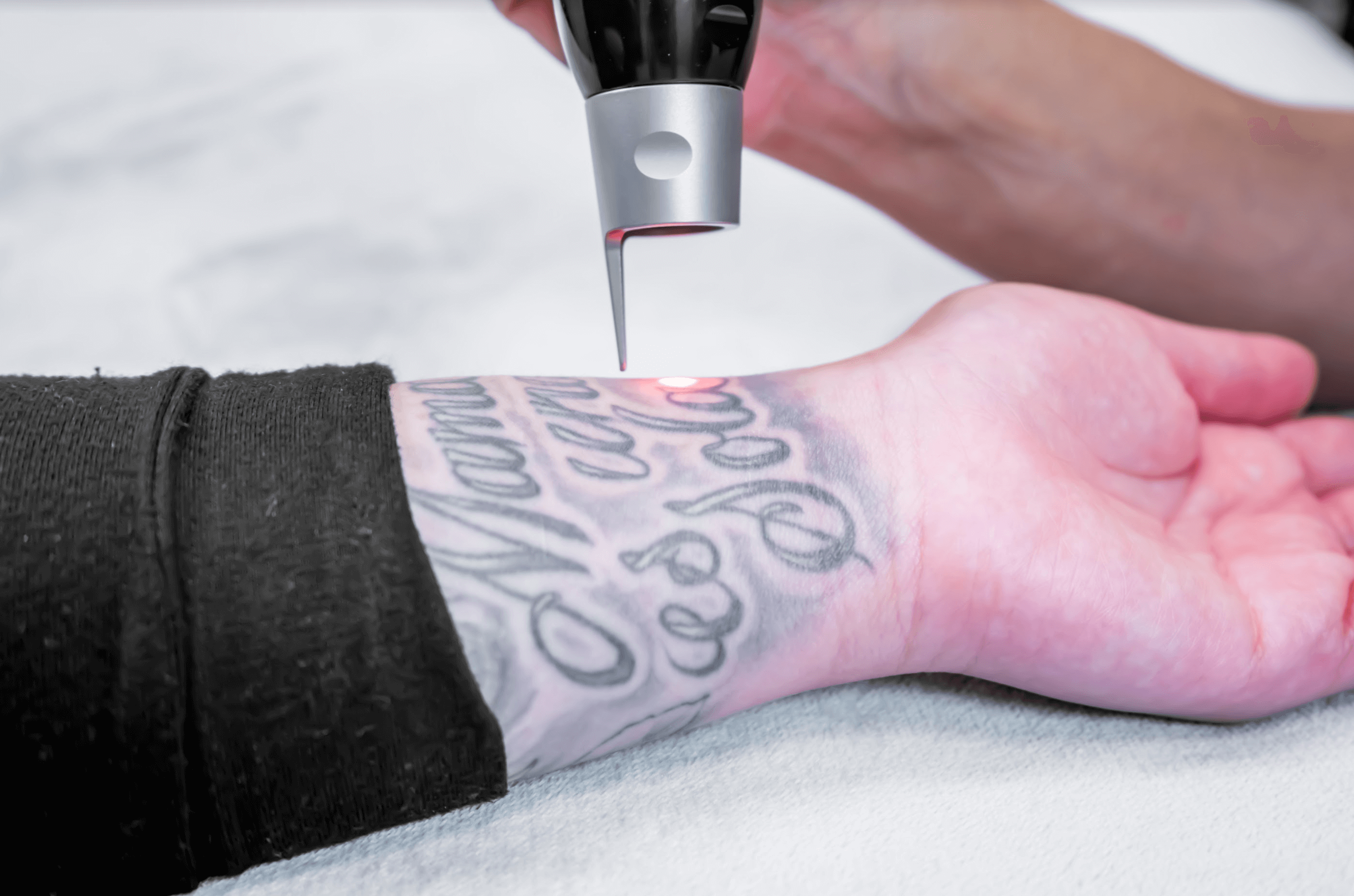 PicoWay Tattoo Removal | Dr. D. Neal Mastruserio, MD, LLC